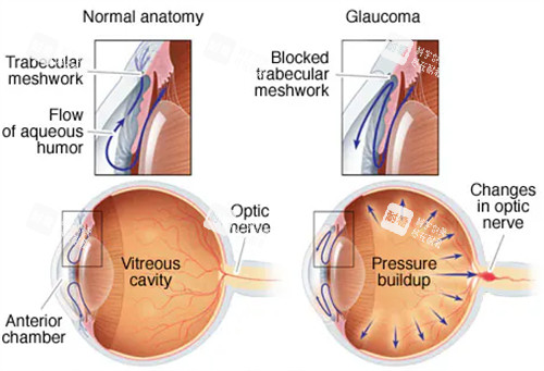 青光眼和正常眼镜眼压区别 青光眼和正常眼镜眼压区别