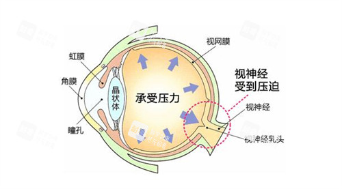 眼压高的因素分享展示 眼压高的因素分享展示
