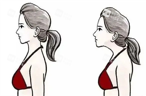 富贵包前后对比图片 富贵包前后对比图片