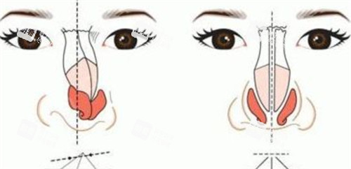 鼻梁矫正对比
