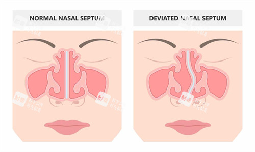鼻修复手术前后对比