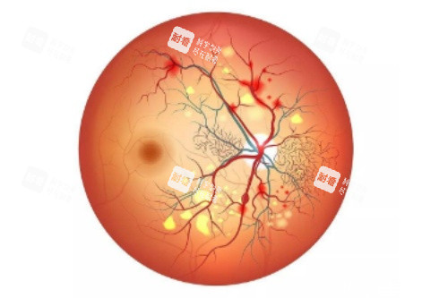 视网膜色素变性概念图
