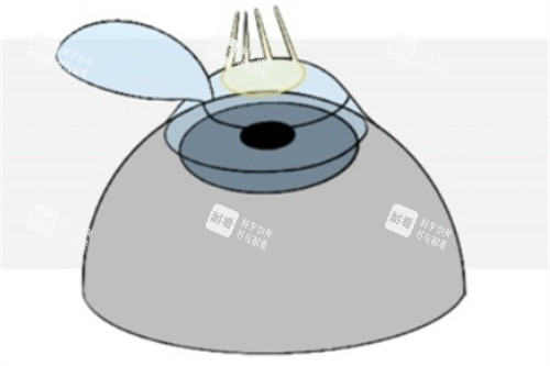 Refractive-Surgery-Techniques-1024x493_副本2
