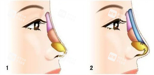 不同材料隆鼻对比 不同材料隆鼻对比