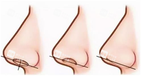 鼻翼缘后缩示意图