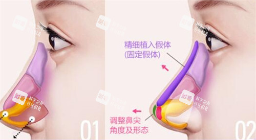 鼻尖假体植入位置