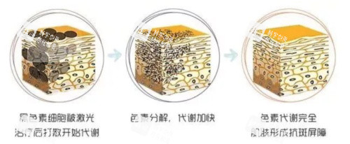 激光祛斑的原理