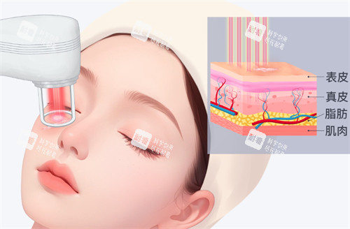 激光去疤过程 激光去疤过程