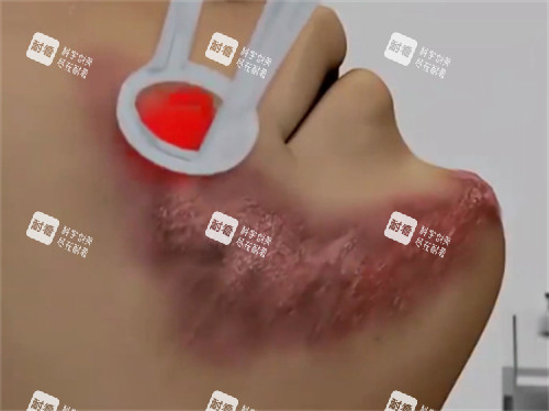 激光去疤的流程 激光去疤的流程