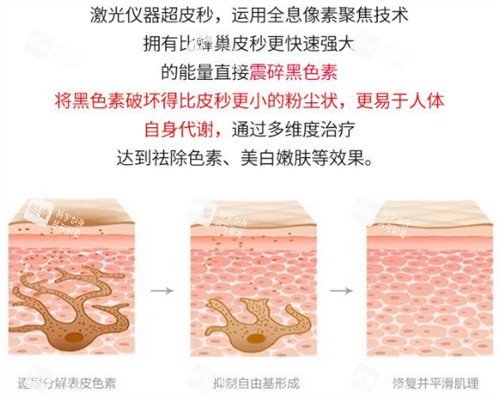 激光祛斑前后的对比 激光祛斑前后的对比