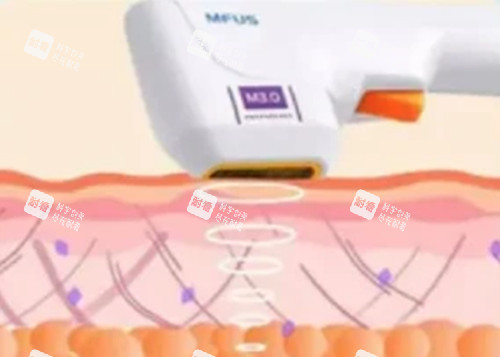 超声炮面部美容卡通示意图 超声炮面部美容卡通示意图
