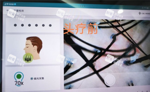 厦门重森植发治疗细节图