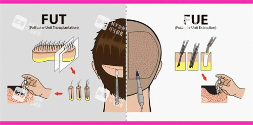 不同植发手术的对比