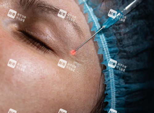 眼周玻尿酸注射