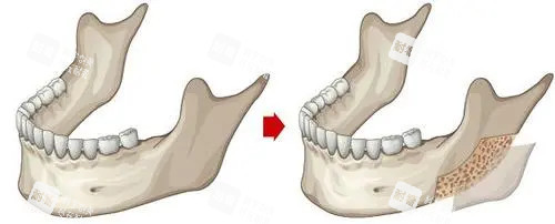 下颌骨外板位置示意图