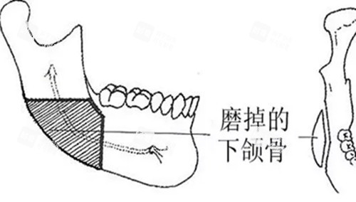 下颌外板位置示意图