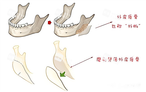 下颌骨切除术过程演示动画图
