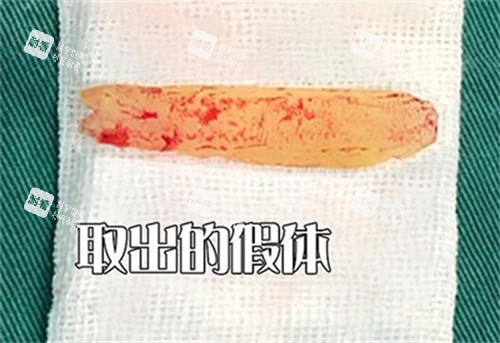 鼻假体取出改善图照片