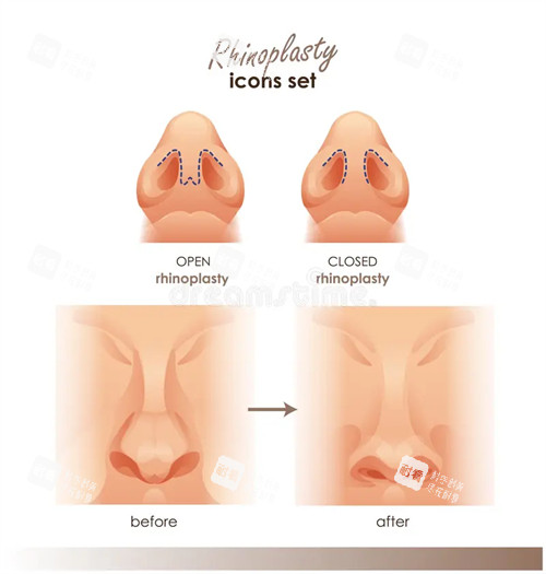 需要矫正的歪鼻