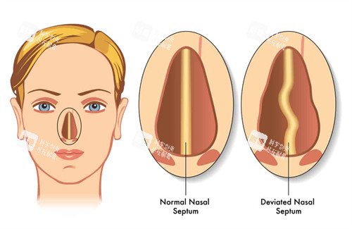 生长歪斜的鼻子
