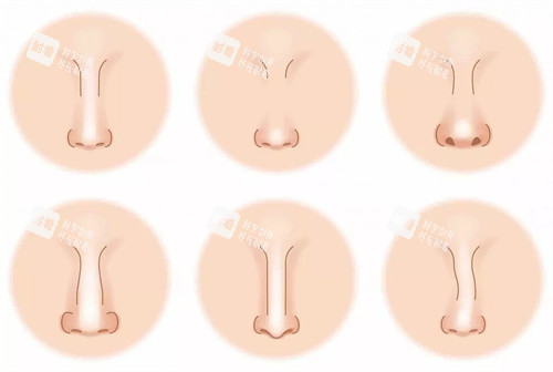 鼻部的不同形态