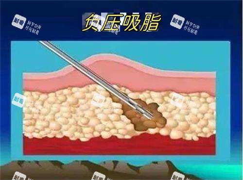 负压吸脂示意图 负压吸脂示意图