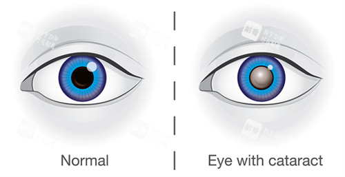 正常眼睛和白内障眼睛不同