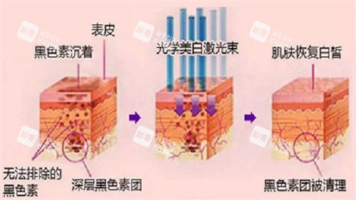 光子嫩肤原理