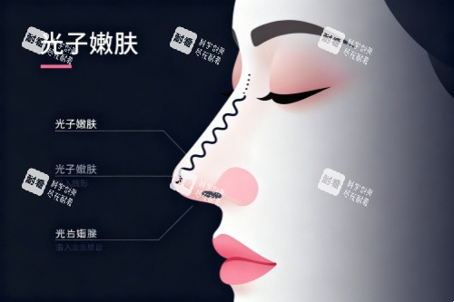 面部做光子嫩肤卡通图