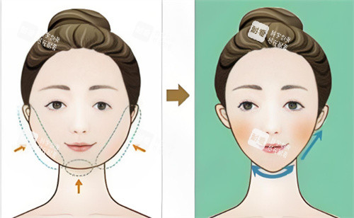 面部吸脂对比卡通 面部吸脂对比卡通