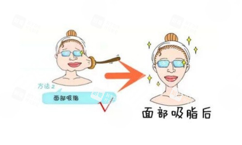 面部吸脂术后示意图 面部吸脂术后示意图