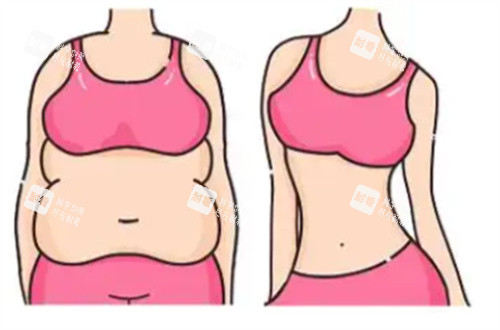 吸脂前后对比图展示