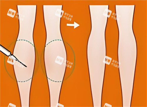 小腿吸脂前后对比