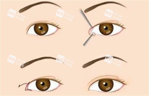 见证奇迹：台州艺星成浩医生让我告别单眼皮，迎来自信新人生！