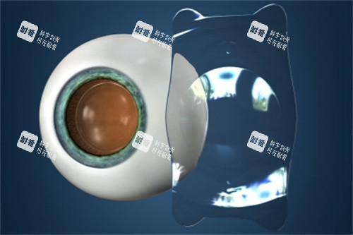 眼睛植入ICL晶体 眼睛植入ICL晶体