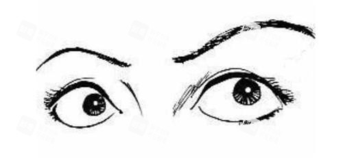 眼睛外凸示意图