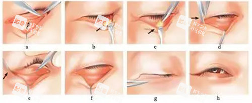 去眼袋手术方法