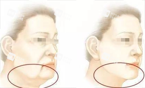 微拉美面部提升动画前后对比图 微拉美面部提升动画前后对比图