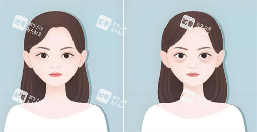 告别眼袋困扰！我在合肥找桑鹏飞医生祛眼袋，术后结果自然宛如天生！