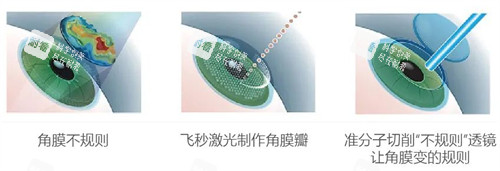 湖北武汉佰视佳眼科好不好？专注近视手术，技术娴熟，摘镜结果超理想