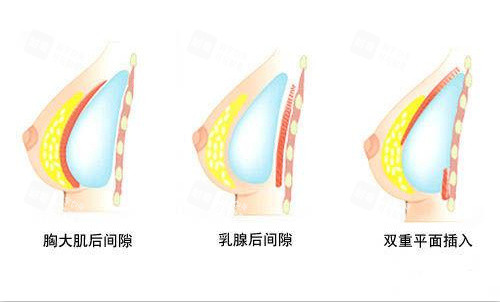 隆胸假体植入方式示意图