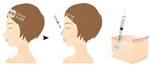 隆鼻玻尿酸原理