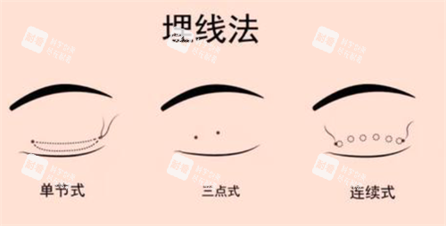 埋线双眼皮经过