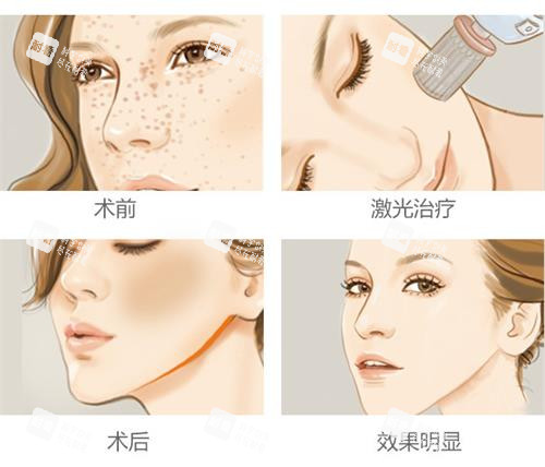 激光祛斑的过程 激光祛斑的过程