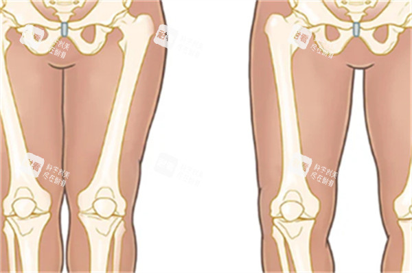 O型腿和直腿的区别图解