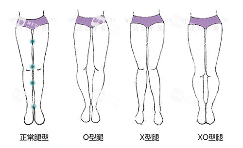 O型腿和X型腿对比图