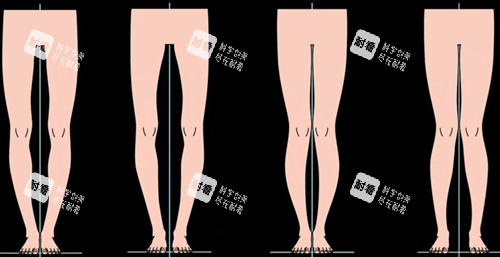 不同腿型卡通示意图
