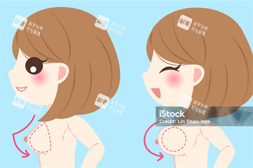 隆胸手术对比展示 隆胸手术对比展示