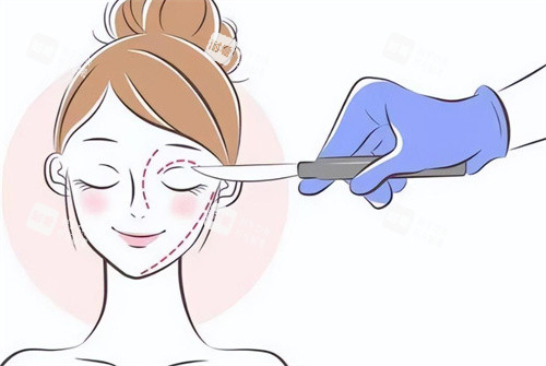 双眼皮手术设计