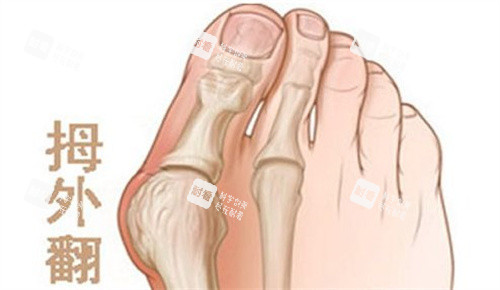 北京望京医院拇外翻手术谁做得好？费用多少？修复过程与就诊体验详细分享！